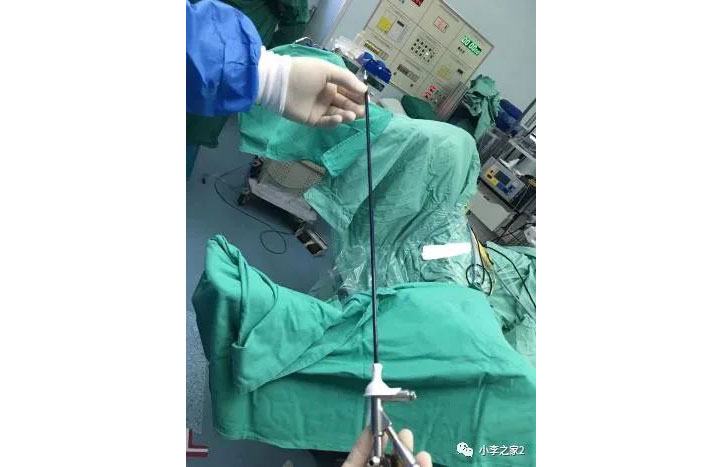 德國:軟鏡腎結(jié)石手術(shù)的預(yù)置支架效果要優(yōu)于輸尿管結(jié)石預(yù)置支架